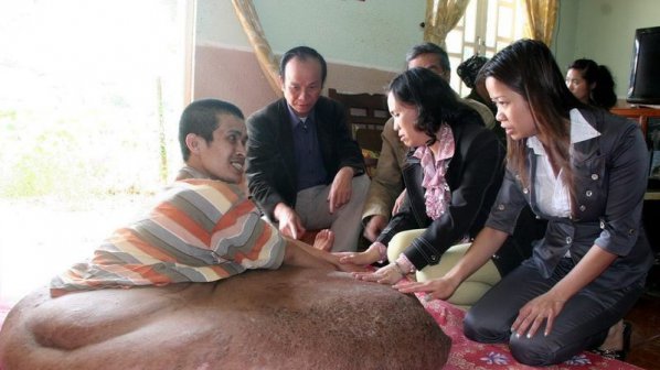 Виетнамец измъчван от 80 - килограмов тумор на крака