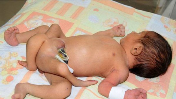В Пакистан се роди бебе с 6 крака (снимка)