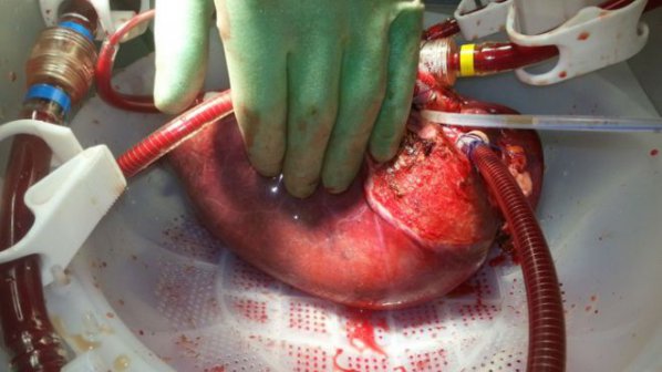 Ново устройство съхранява органи за трансплантация