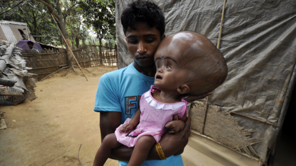 Индийче страда от рядката болест на огромната глава