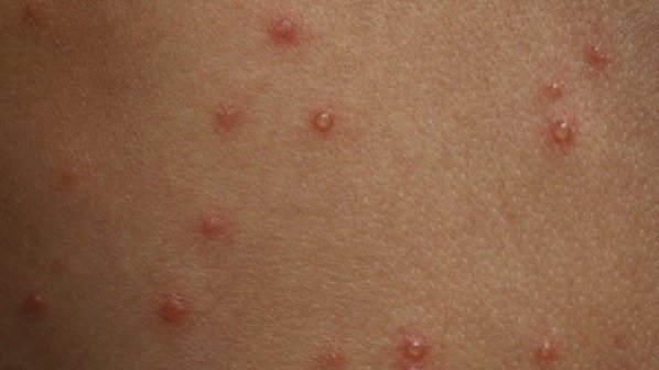 14 деца се разболяха от варицела в Ловеч