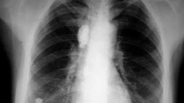 27% повече болни от туберкулоза в Сливенско, отчете местната болница
