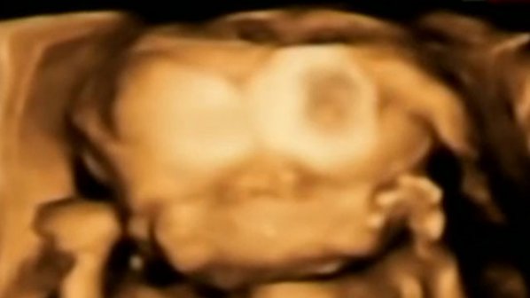 Майка на 7 деца роди бебе с две лица (видео)