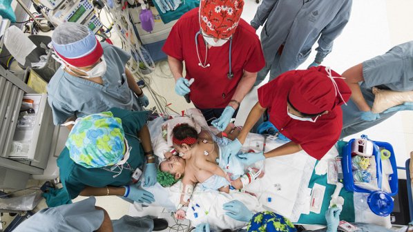 Разделиха сиамски близначки с 26-часова операция (снимки)