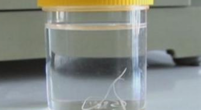 Извадиха 10-сантиметров червей от окото на шивачка (снимка)