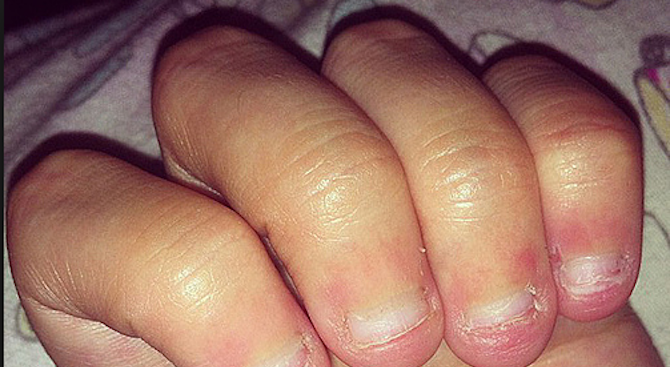 Гризането на нокти може да доведе до смърт