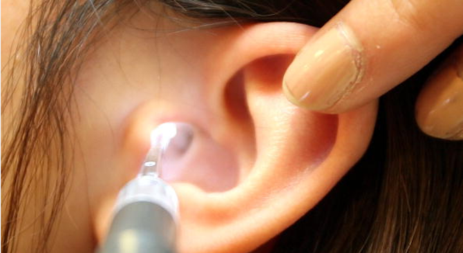 Клечките за уши са най-лошият вариант за почистване на ушите