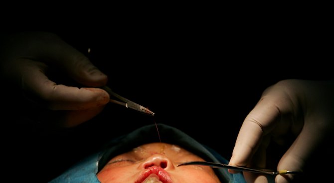 Близо сто деца се раждат годишно с лицеви аномалии