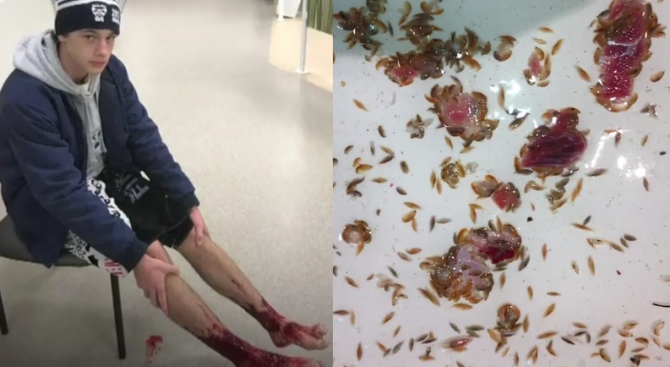 Морски животинки нахапаха до кръв тийнейджър в Мелбърн (видео 18+)