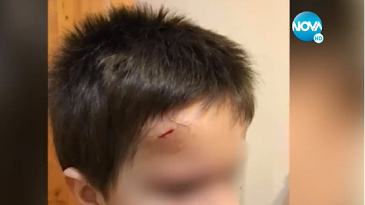В детска градина: Синини и следи от забит молив в челото