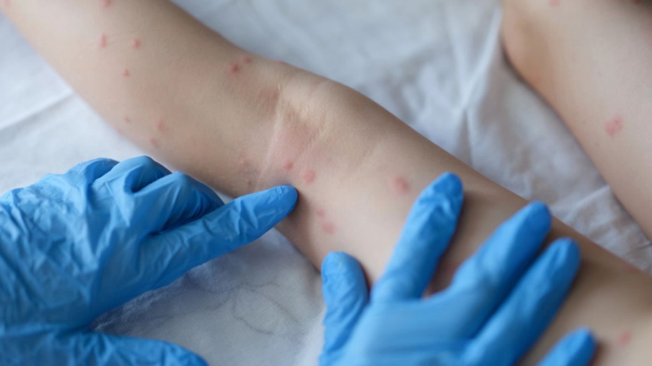 Скок на заразените с варицела в Монтанско