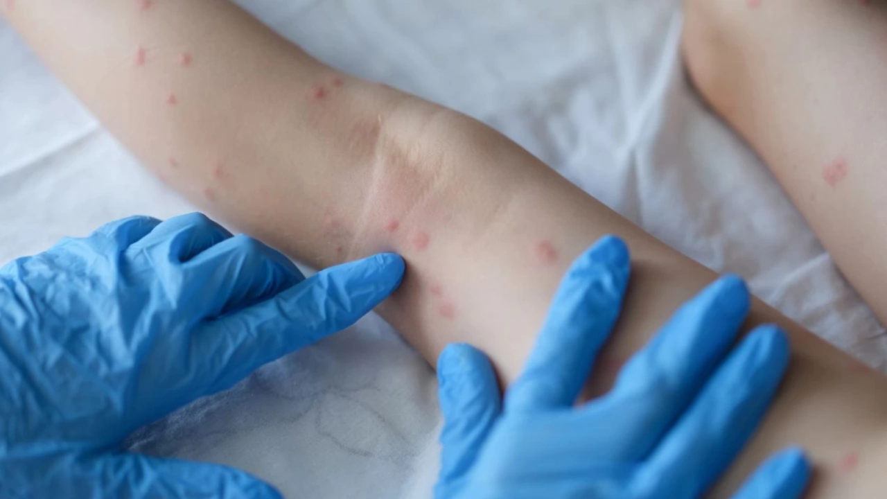Драстичен ръст на случаите на варицела отчитат здравните власти в Монтанско 432 са