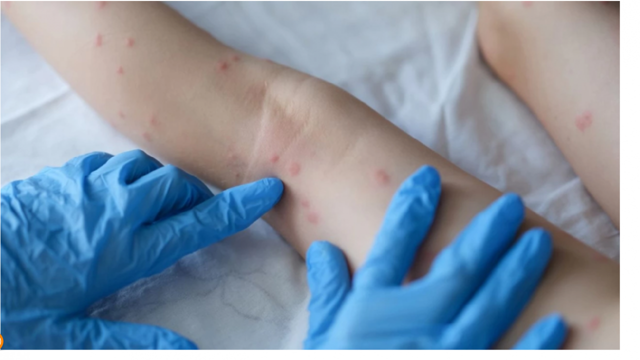 Ръст на случаите на варицела в Девин отчитат от Регионалната